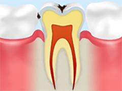 レベル2C1：エナメル質の虫歯
